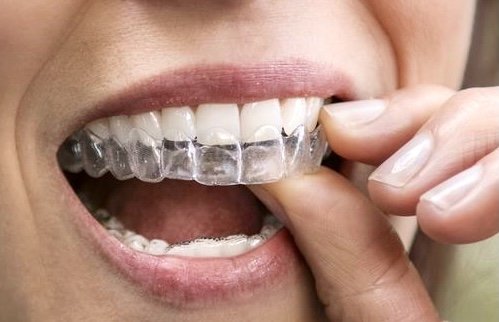 Invisalign-Go Zahnarztpraxis in Berlin - Zahnästhetik